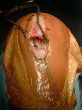 Chirurgie du genou