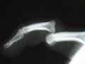 080211_02_luxation_digitale